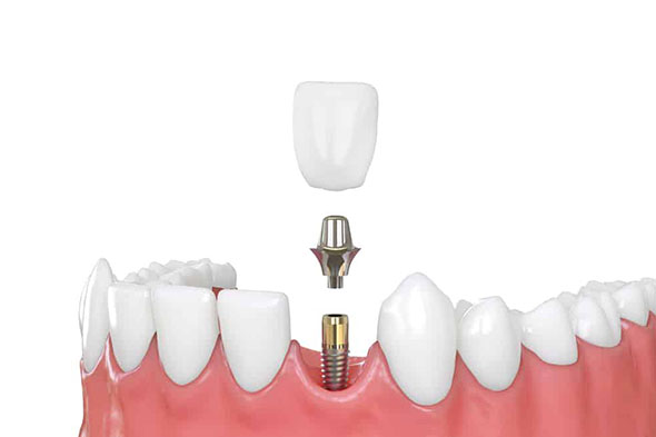 dental implants in Adelaide