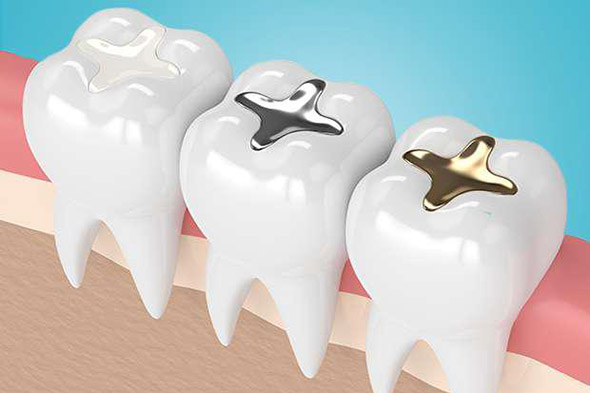 tooth coloured fillings Adelaide