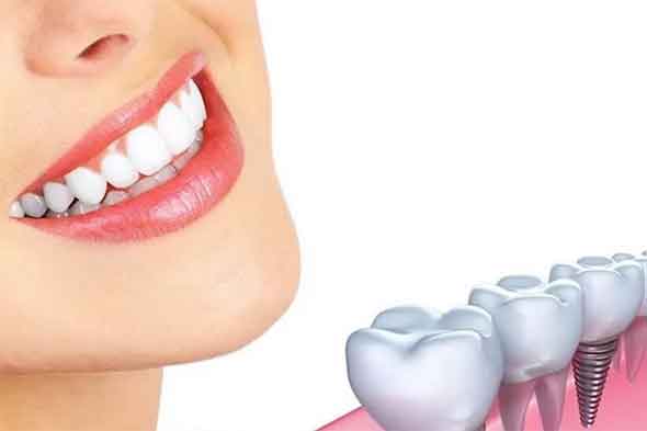 tooth replacement options Adelaide