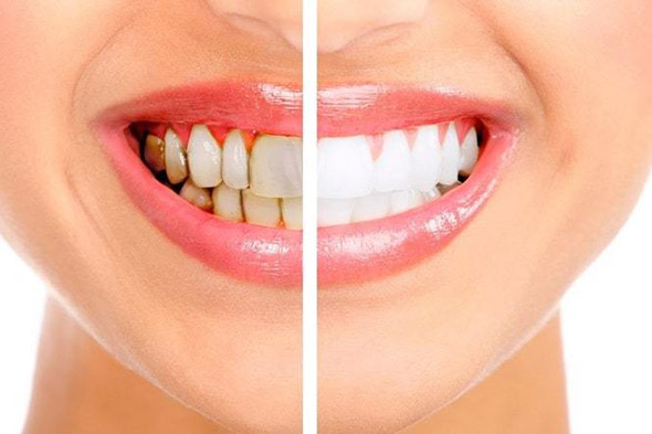 Tooth Whitening in Adelaide