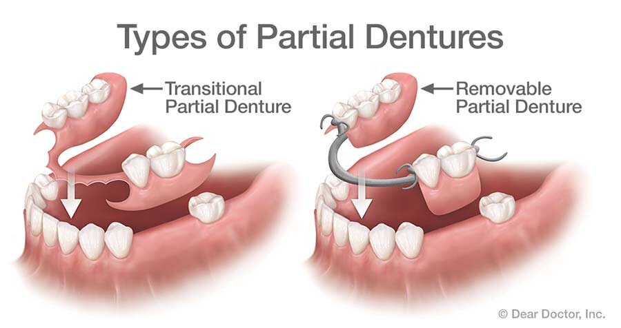 partial dentures Adelaide